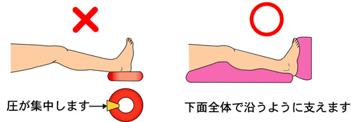 踵部を除圧する場合のクッションの使用例