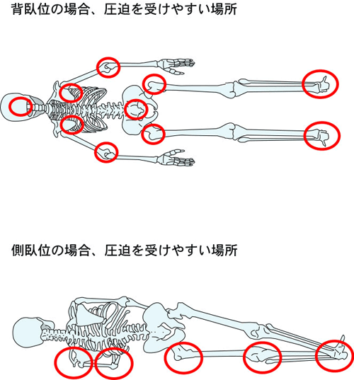 圧迫を受けやすい部位 圧迫を受けやすい部位