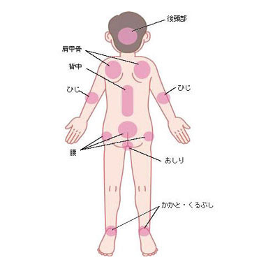 床ずれのできやすい場所 床ずれのできやすい場所