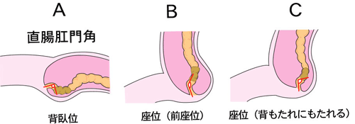 姿勢と直腸肛門角の関係 姿勢と直腸肛門角の関係